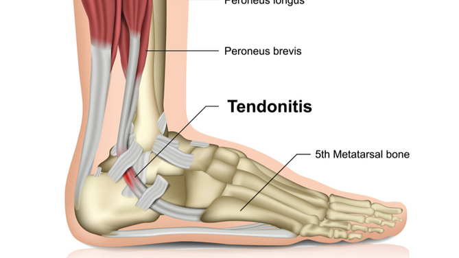A Guide to Tendonitis